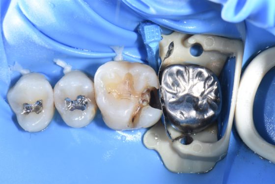 第一歯科術中