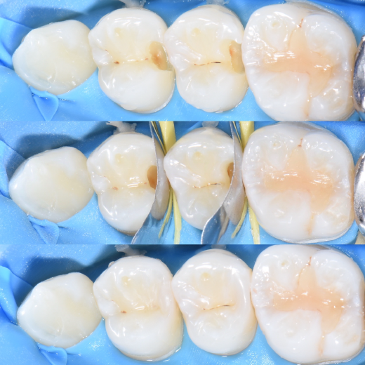 MI治療をする歯科衛生士