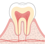 歯肉炎(初期)のイラスト