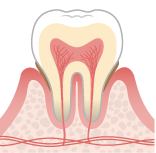 軽度歯周炎のイラスト