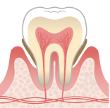 中等度歯周炎のイラスト