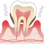 重度歯周炎のイラスト