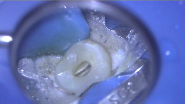 宇部市 歯の神経