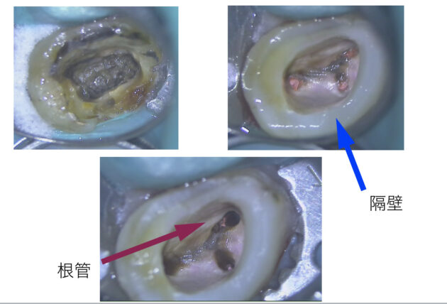 宇部市根管治療