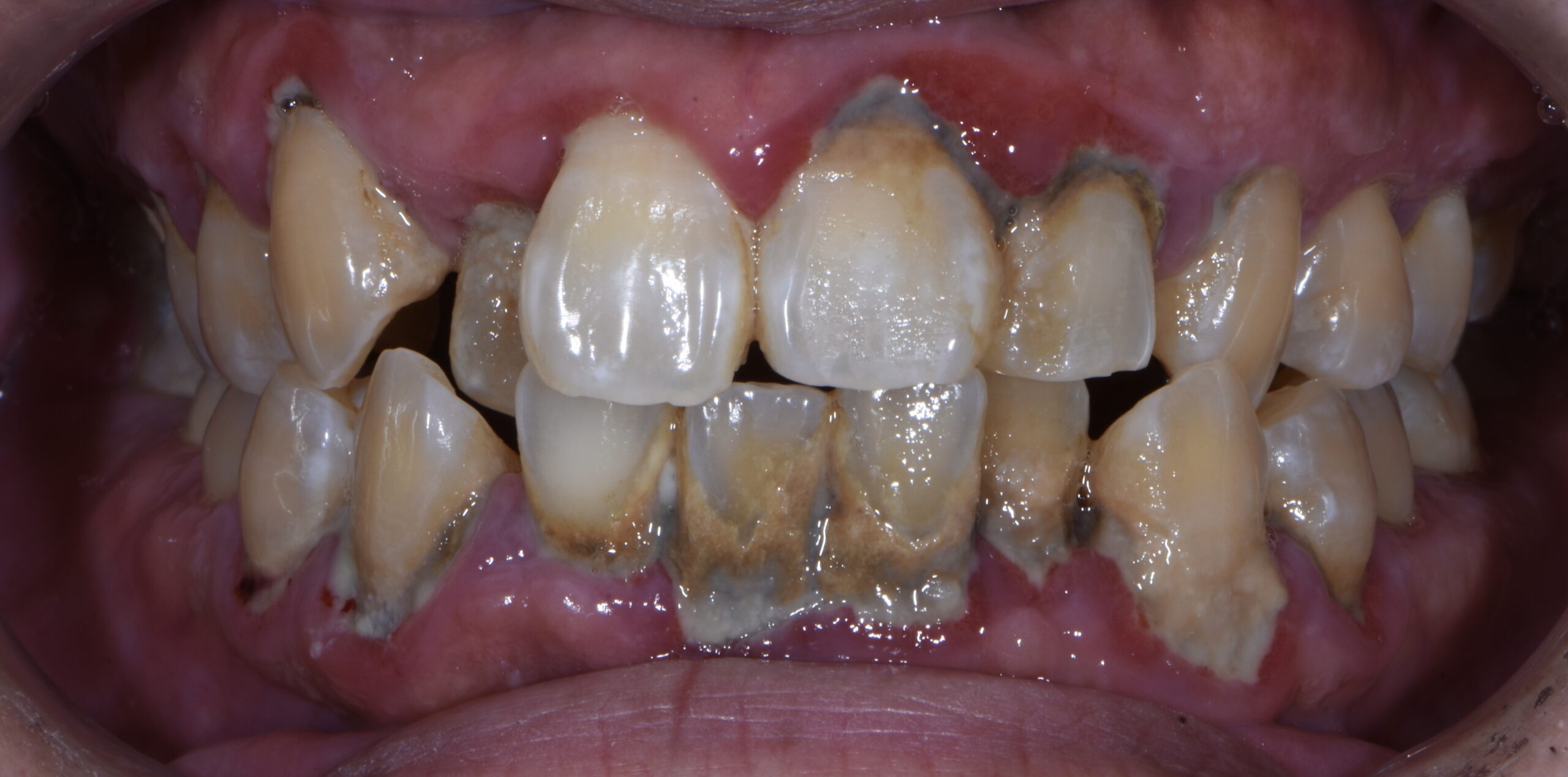 歯石除去を中心とした予防歯科治療 治療前