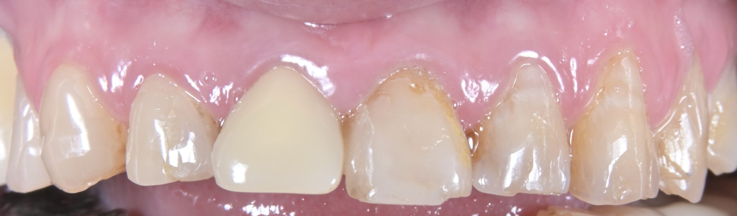 詰め物の反復脱離と咬合痛に対する全顎的治療 治療前