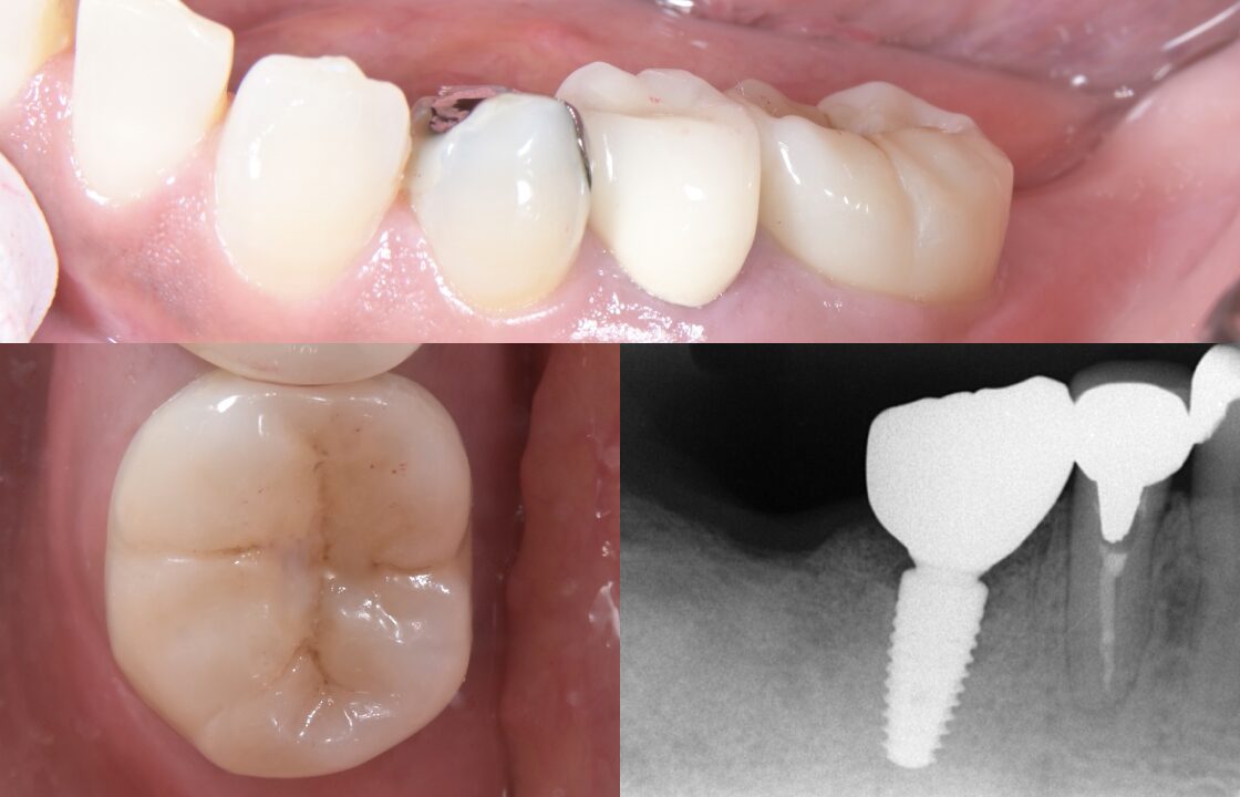 歯根破折により抜歯を要した症例への即時埋入インプラント治療 治療後