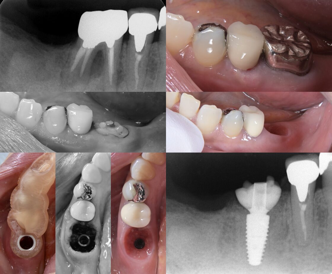 歯根破折により抜歯を要した症例への即時埋入インプラント治療 治療前