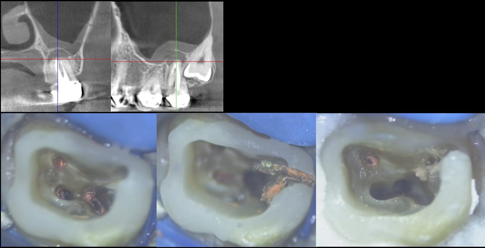 再治療（イレギュラーかつ見逃された根管） 治療前