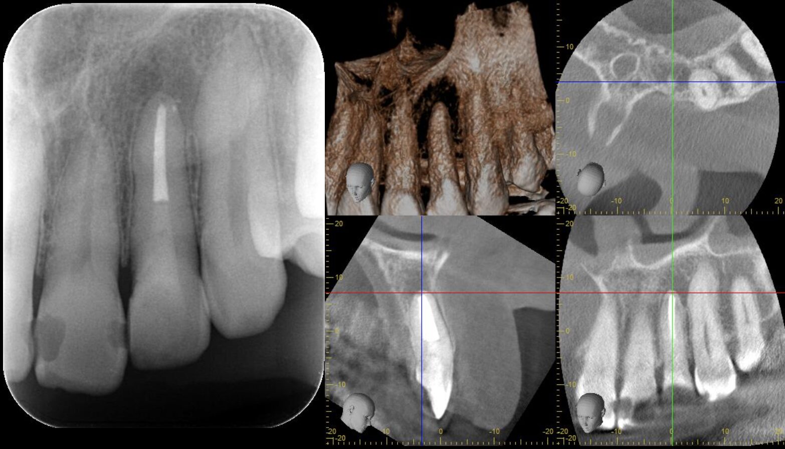 広範囲の骨吸収を認める再治療　（メタルポスト除去） 治療後