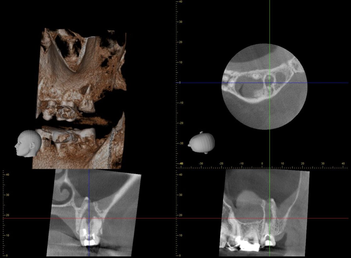 上顎洞へ交通する根尖性歯周炎（歯髄壊死）の再治療 治療前