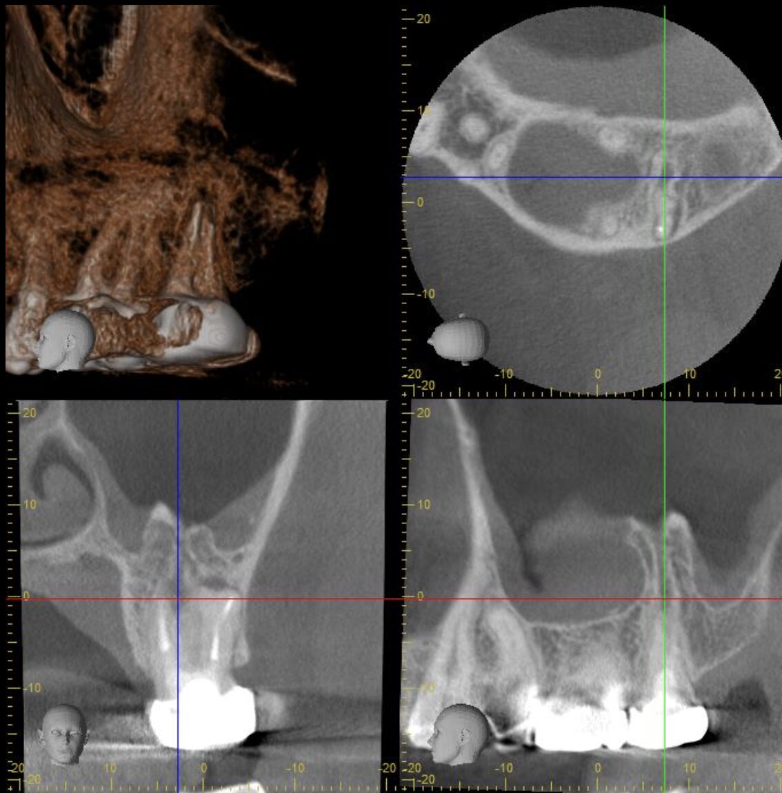 上顎洞へ交通する根尖性歯周炎（歯髄壊死）の再治療 治療後