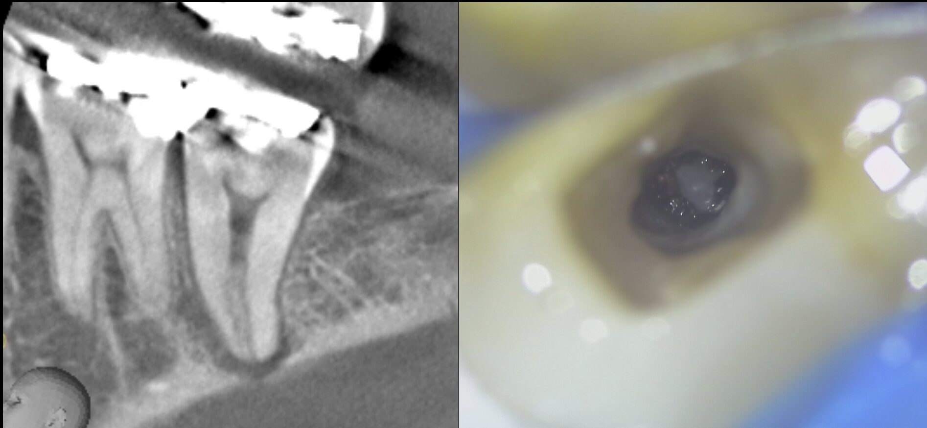 歯髄結石 治療前