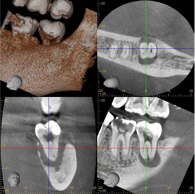 歯髄壊死と根尖性歯周炎、エンドペリオ病変 治療前