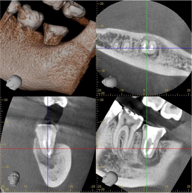 歯髄壊死と根尖性歯周炎、エンドペリオ病変 治療後