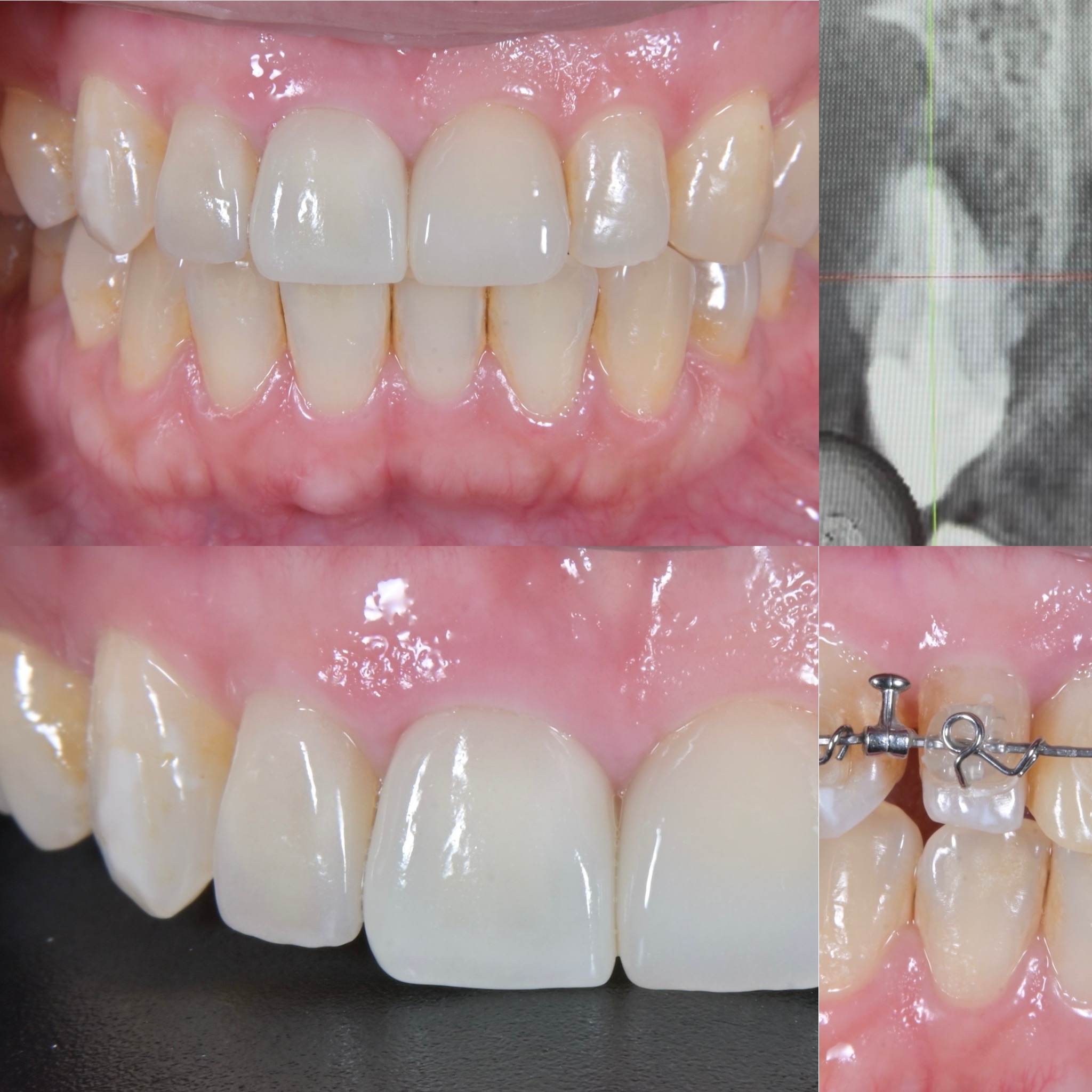 部分矯正を併用した前歯部審美歯科治療 治療後