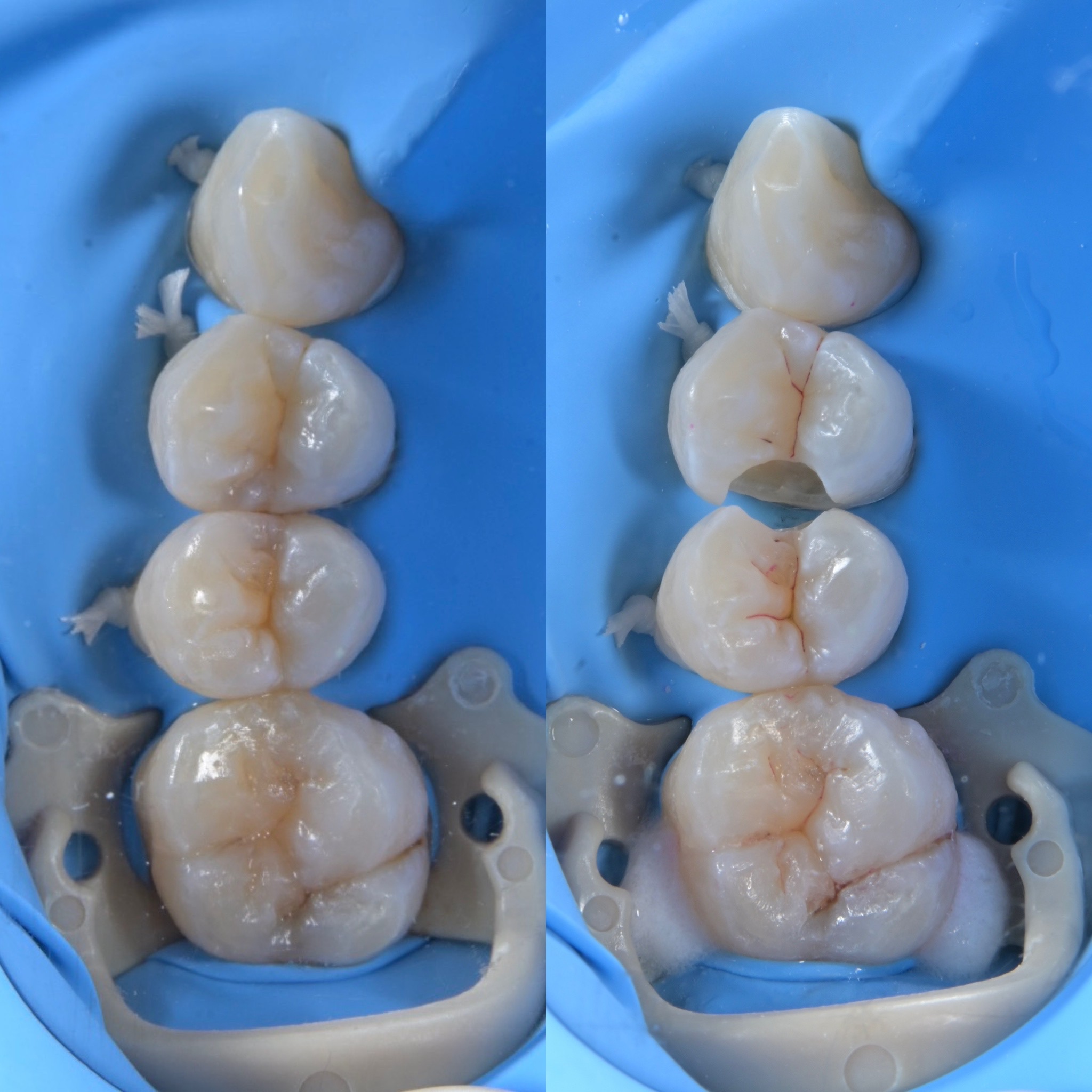 虫歯治療・ダイレクトボンディング（ダイレクトレストレーション） 治療前