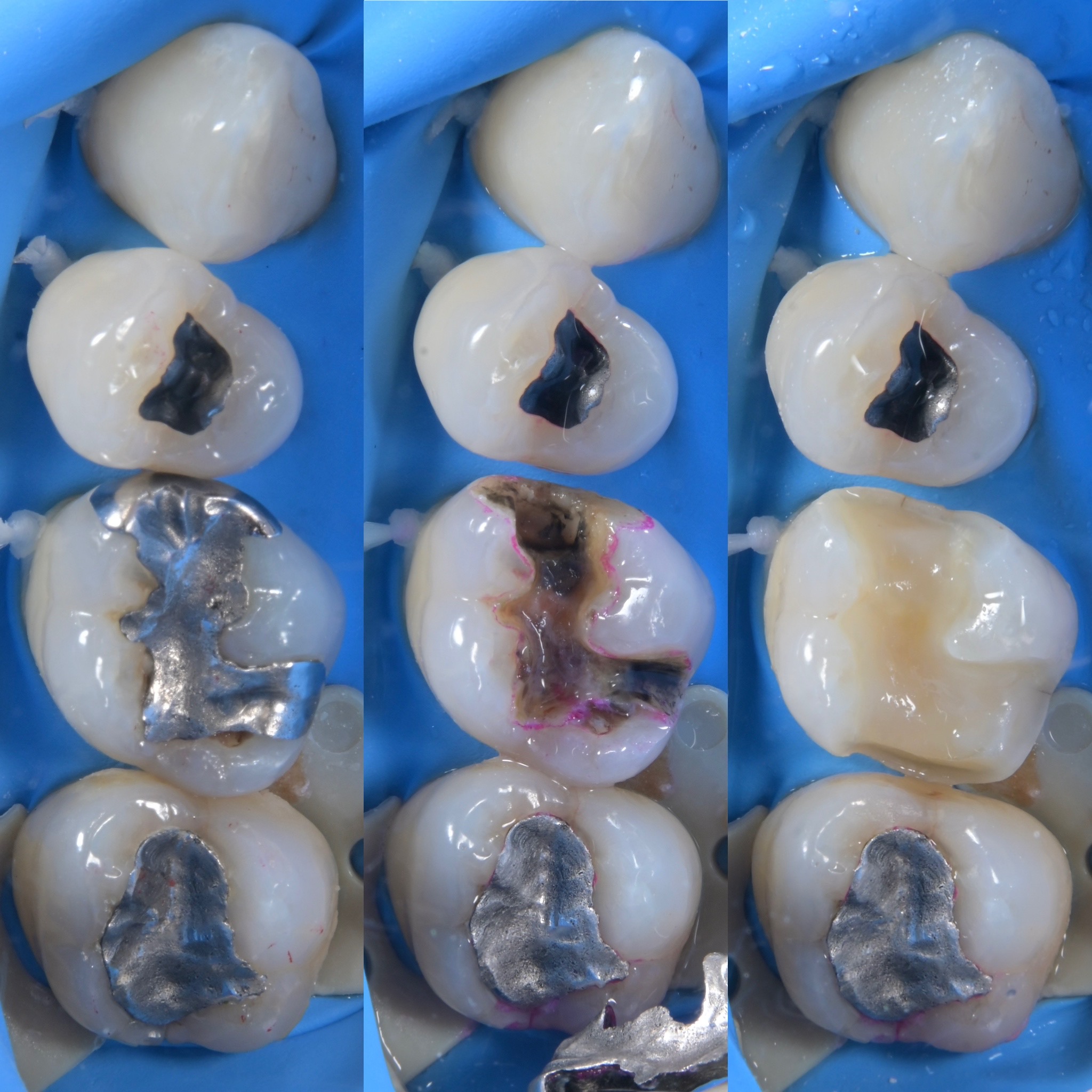 インダレクトレストレーション（セラミックインレー） 治療前