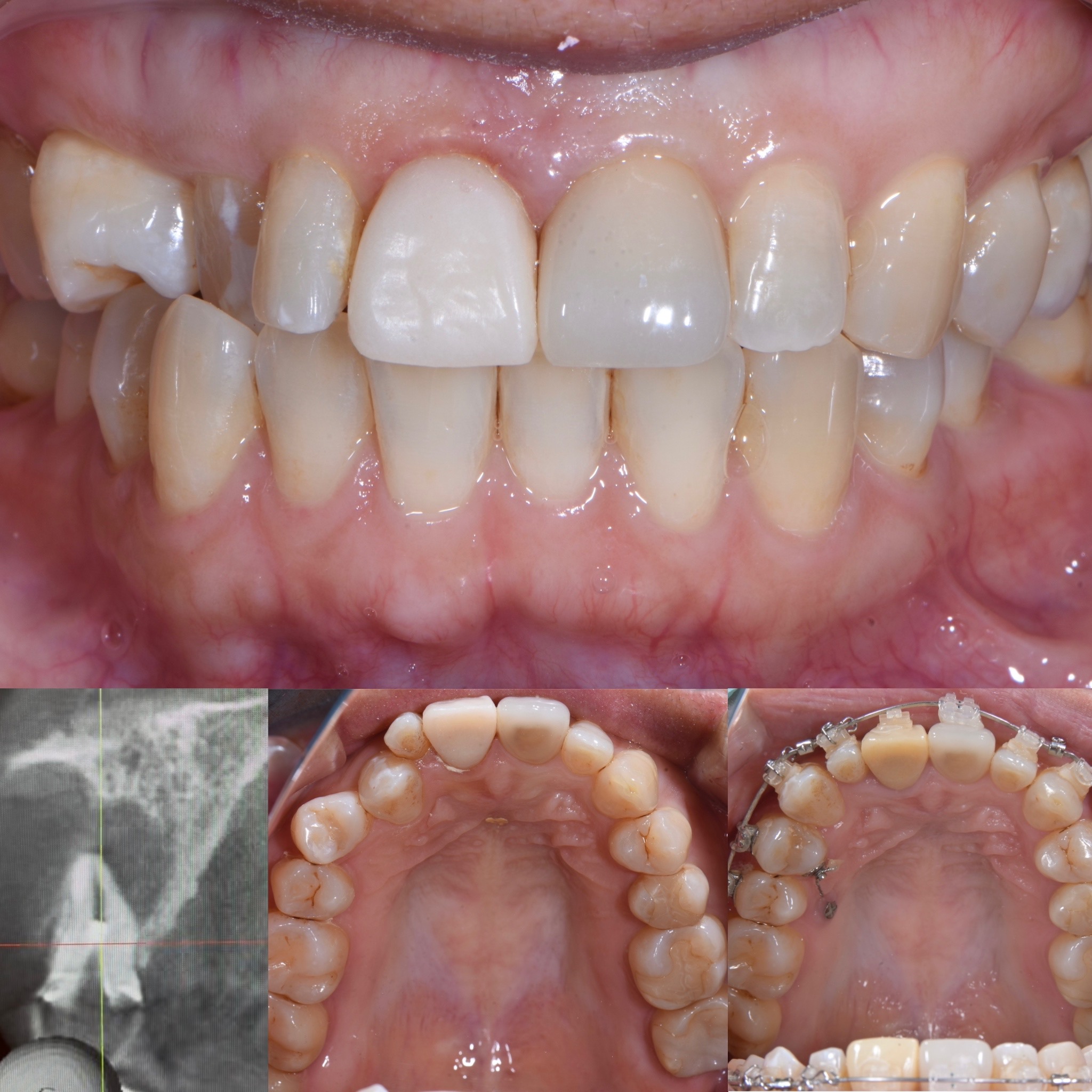 部分矯正を併用した前歯部審美歯科治療 治療前