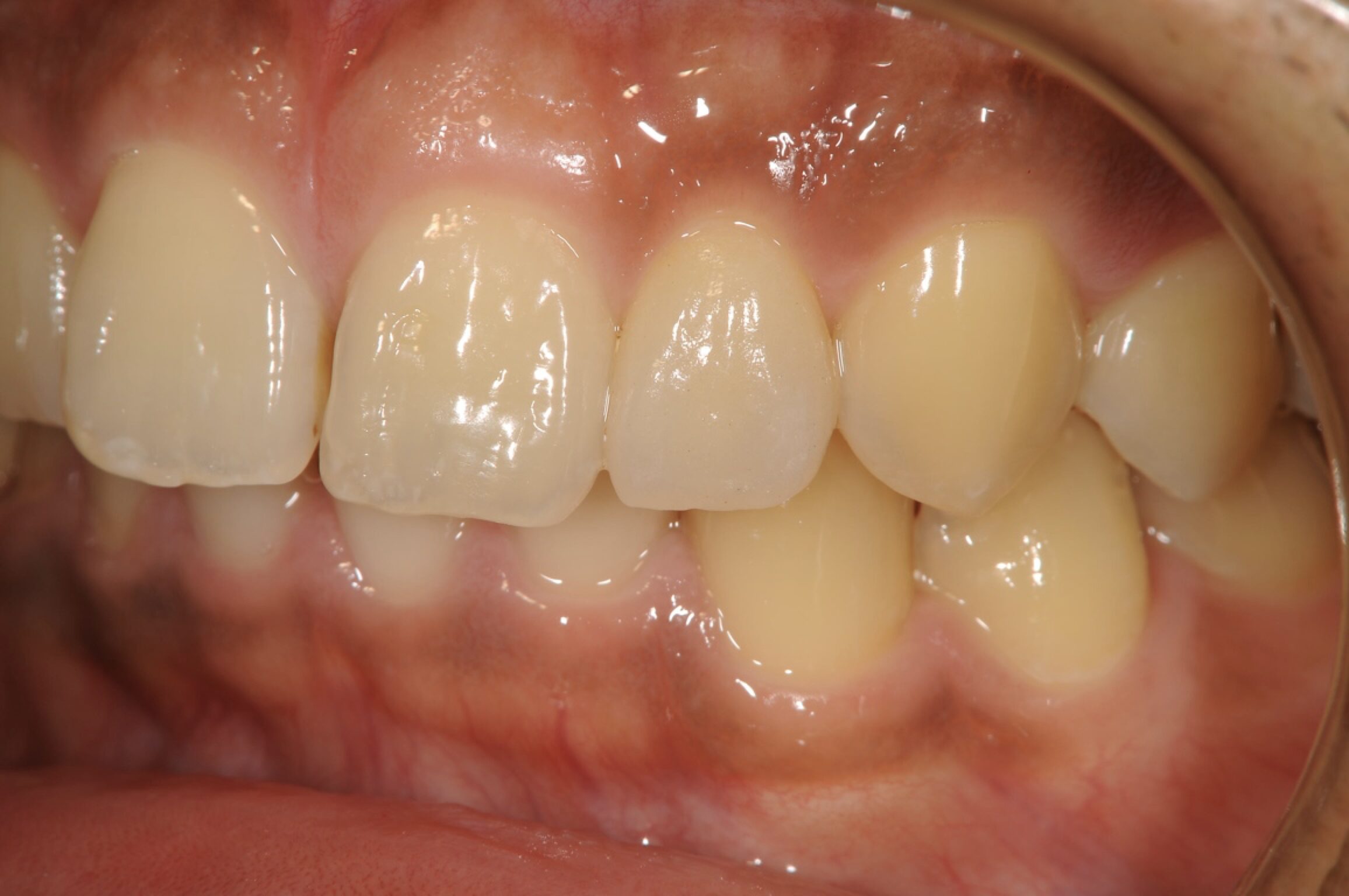 矮小歯に対してラミネートベニアで修復しました 治療後