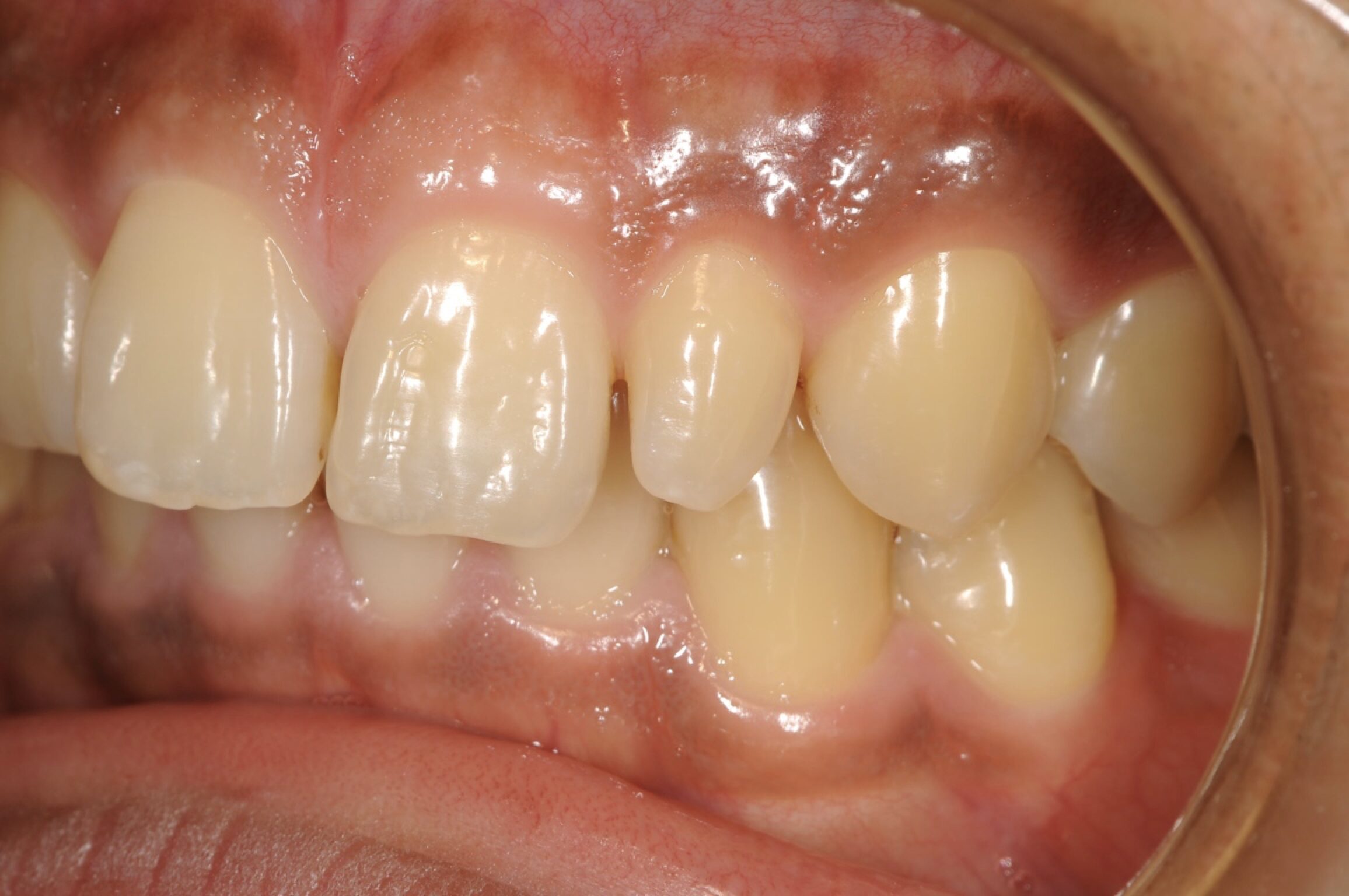 矮小歯に対してラミネートベニアで修復しました 治療前