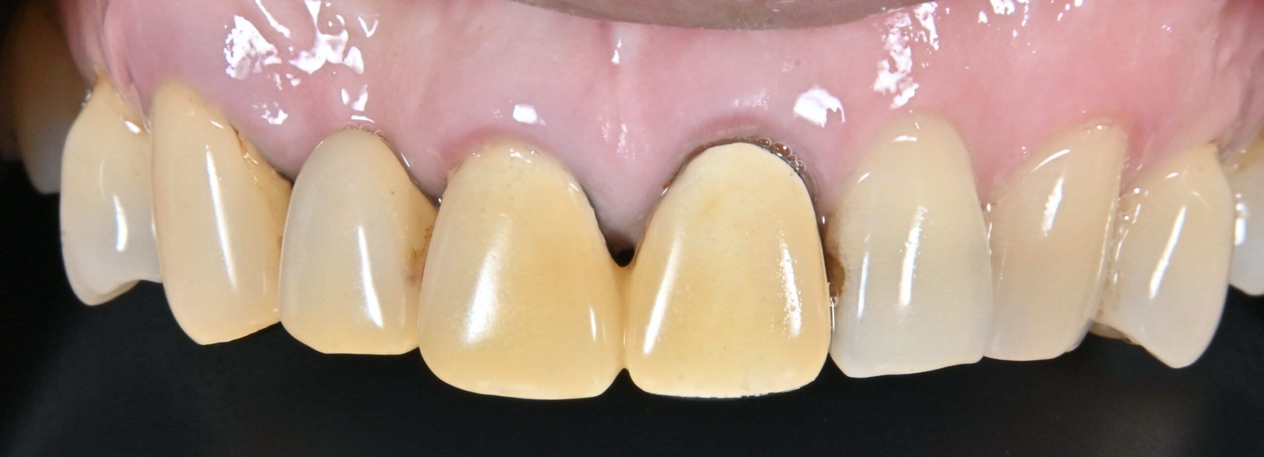 審美歯科治療　セラミックブリッジ（ジルコニアブリッジ） 治療前