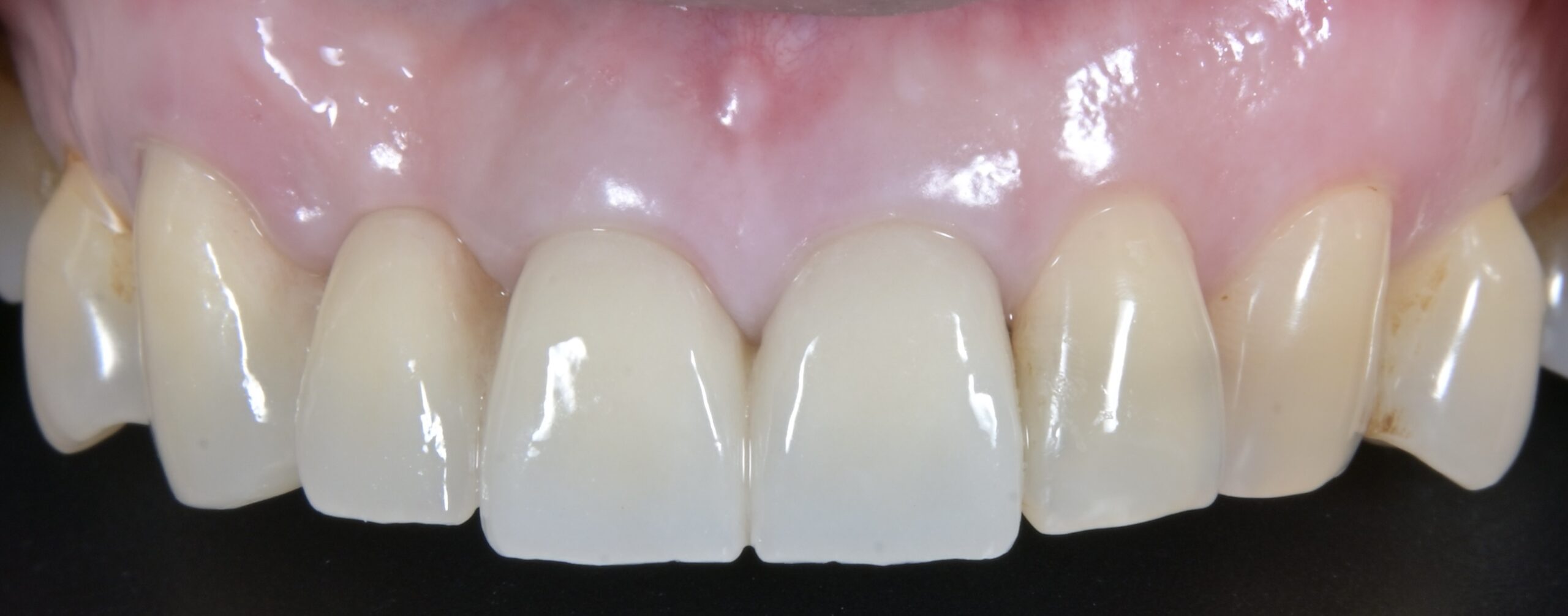 審美歯科治療　セラミックブリッジ（ジルコニアブリッジ） 治療後