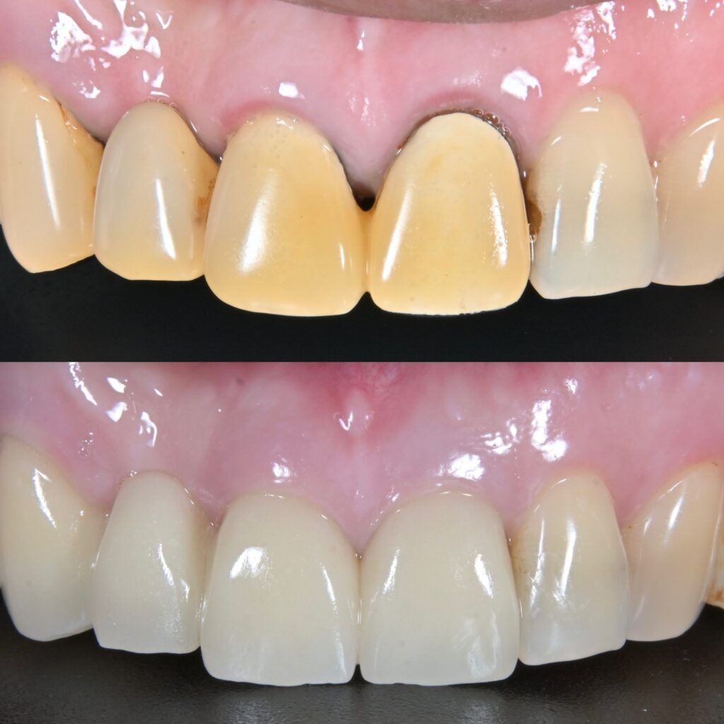 審美歯科治療（セラミック治療）を成功させるために必要なこと〜宇部市歯医者〜